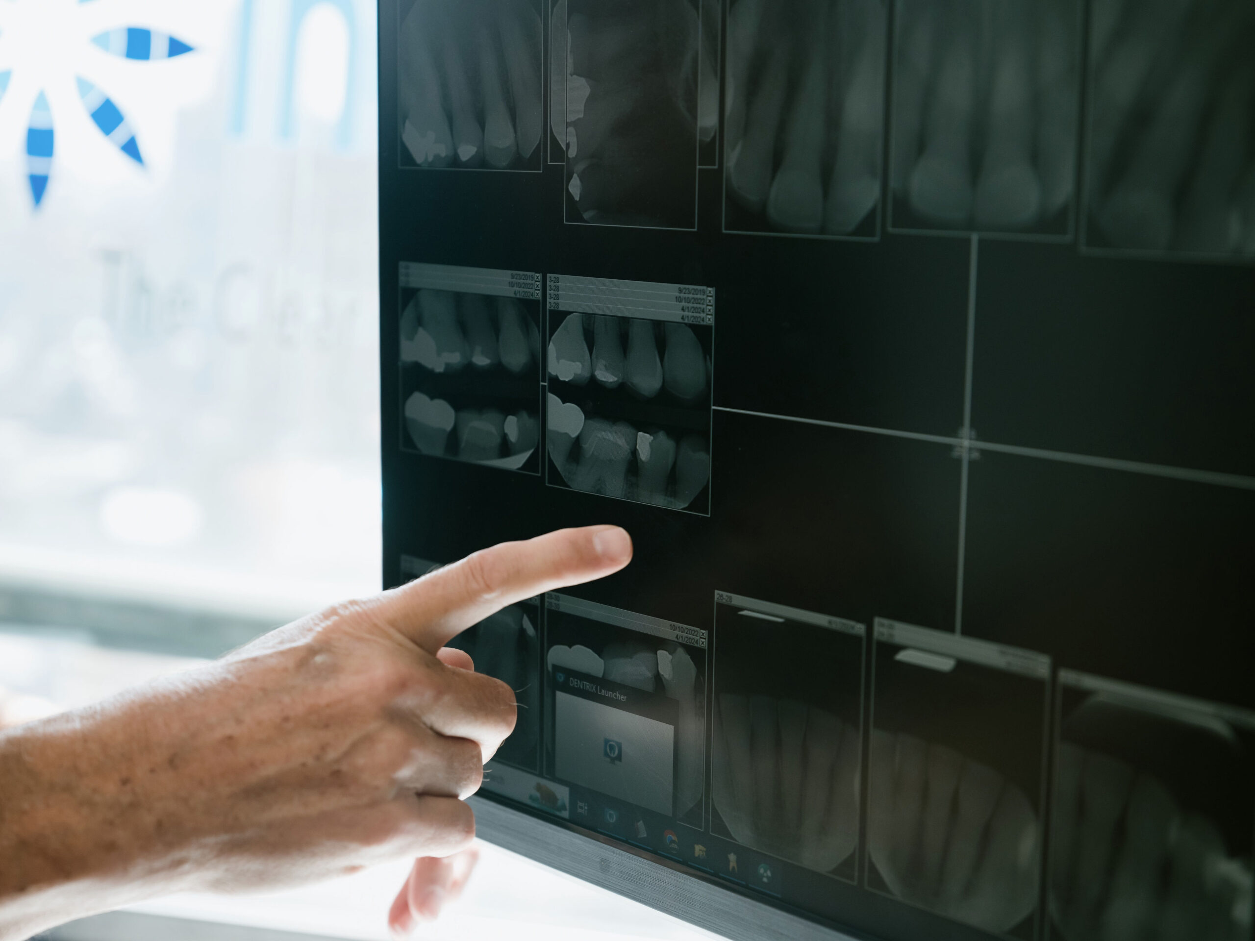 Guided Implant Placement