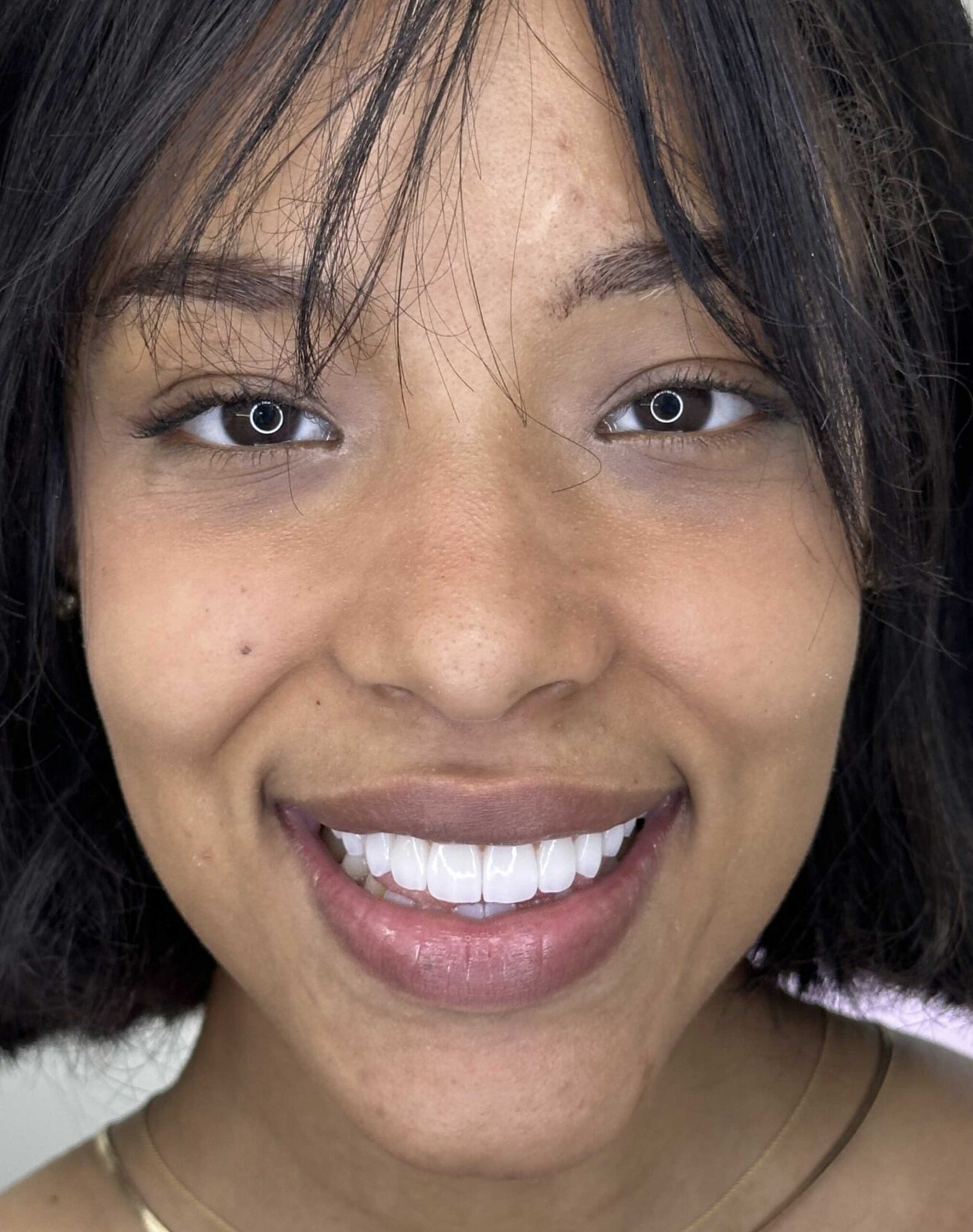 Before image of a Manhattan Dental Spa patient after dental implants