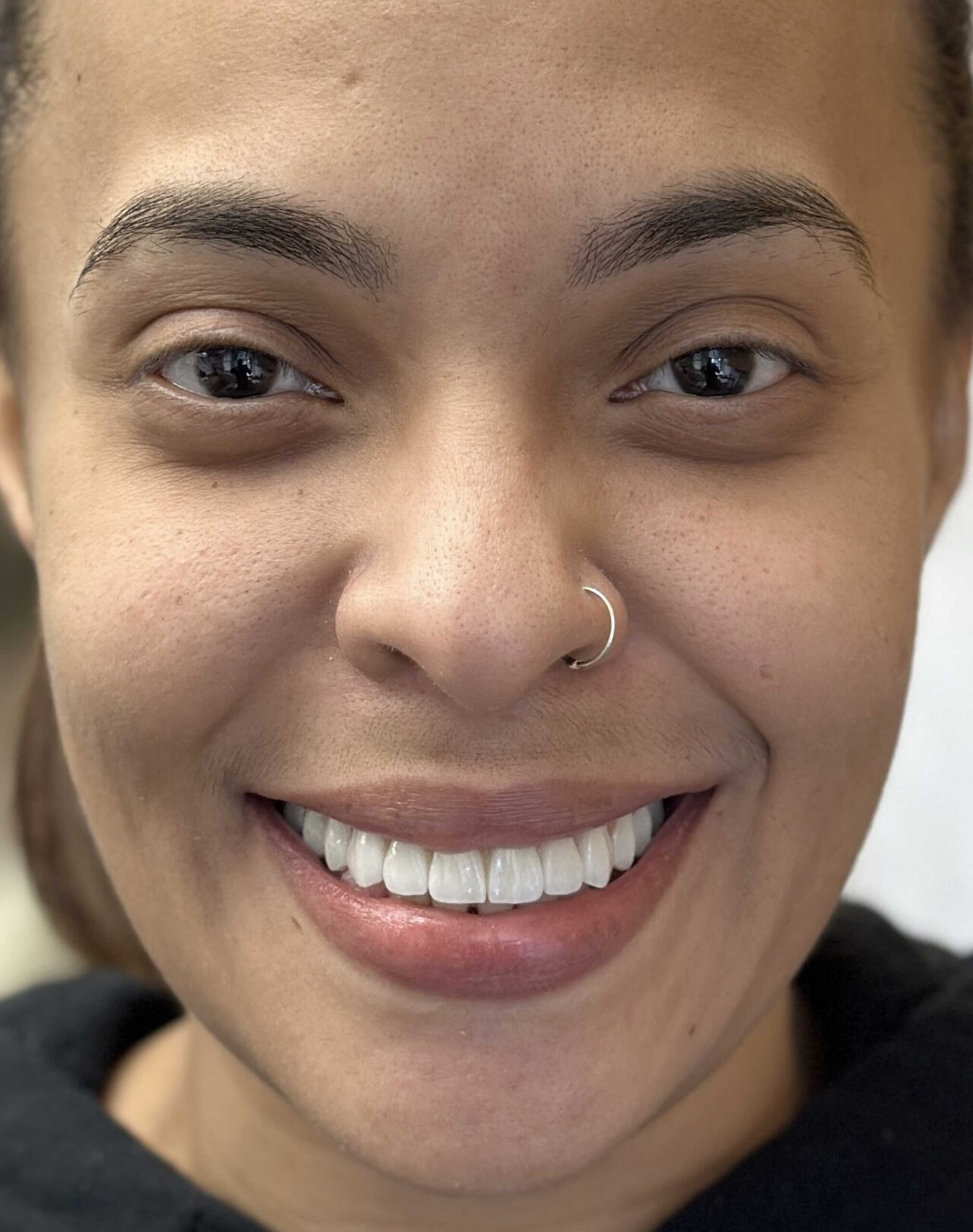 After image of a Manhattan Dental Spa patient after dental implants