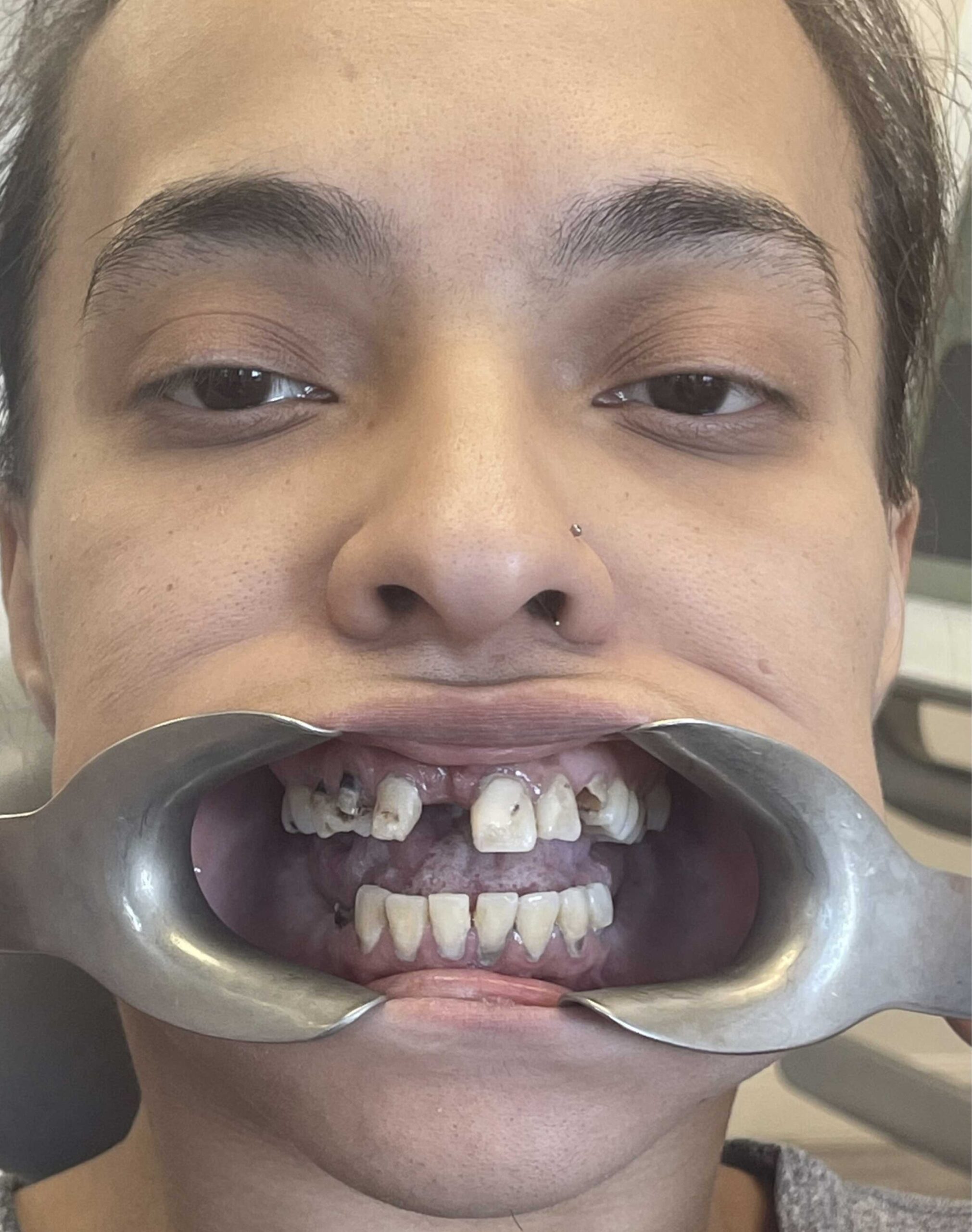 Before image of a Manhattan Dental Spa patient