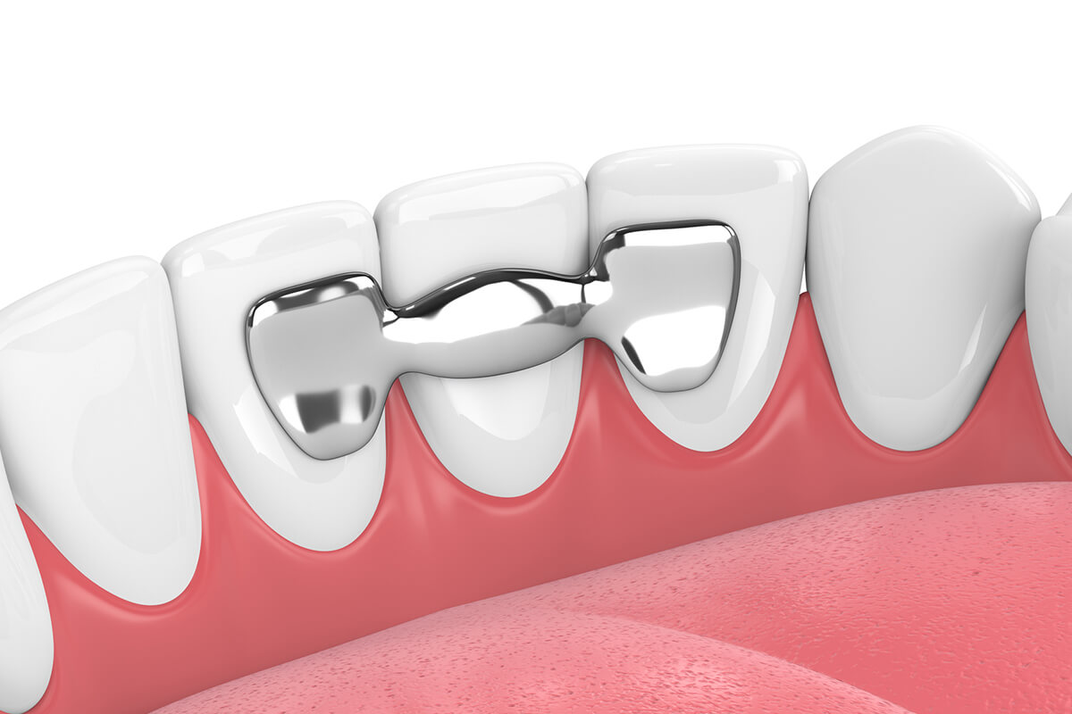 how-long-does-a-dental-bridge-last-nyc